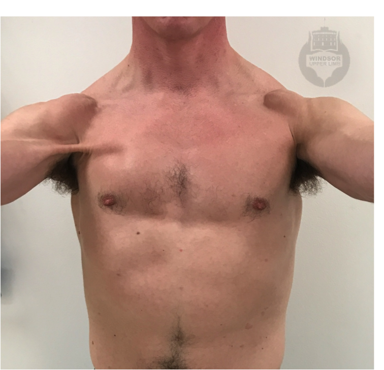 Pectoralis Major Rupture